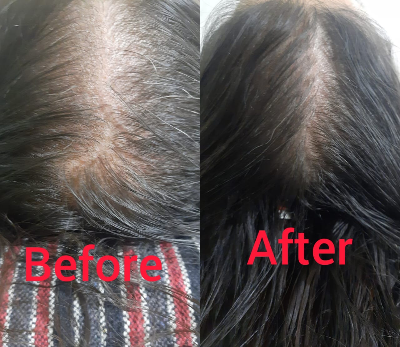 Hair Thinning & Natural Regrowth with Ayurvedic Treatment